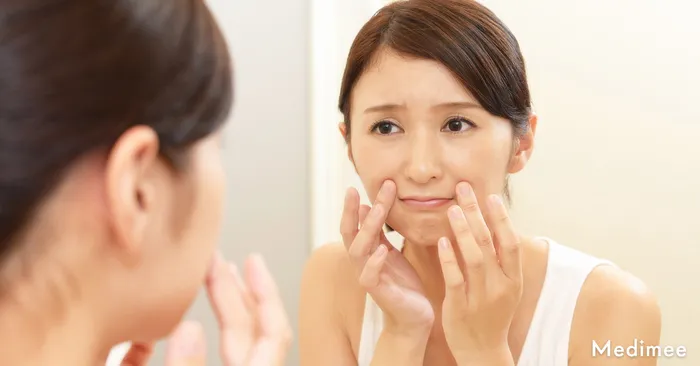 ポテンツァで肝斑が悪化することはある?施術のリスクと注意点を徹底解説
