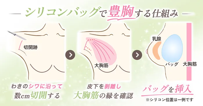 【必見】豊胸したら後悔するって本当？デメリットも合わせておすすめの豊胸術を徹底調査