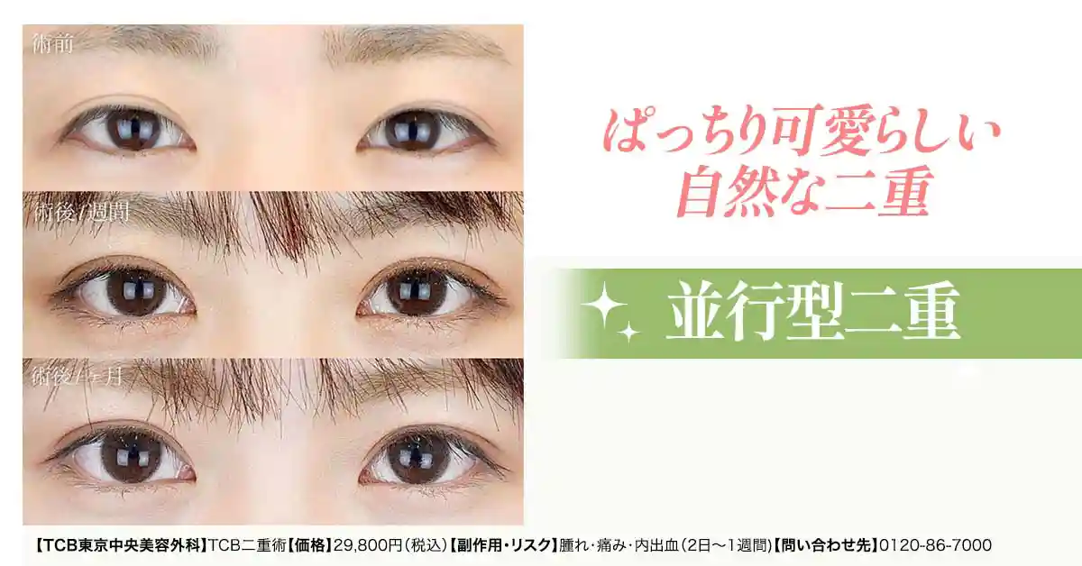 東京中央美容外科の二重埋没の施術症例画像
