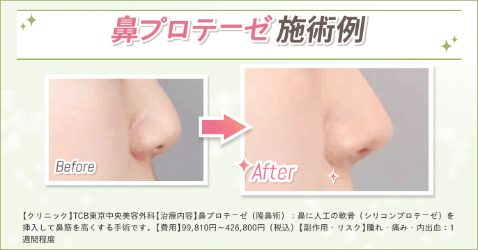 鼻プロテーゼのBA画像