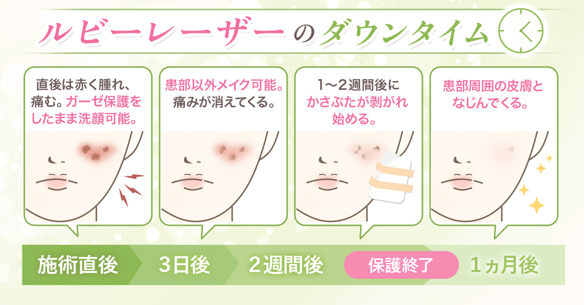 ダウンタイム
