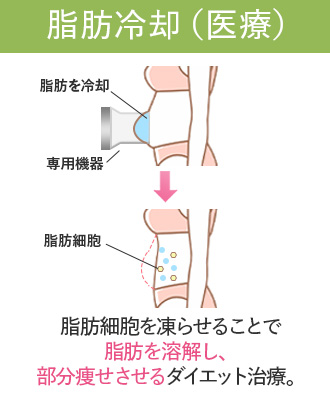 【最新版】脂肪冷却のおすすめクリニック5選！クールスカルプティングは本当に効果あるの？